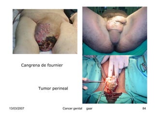 Cáncer Genital