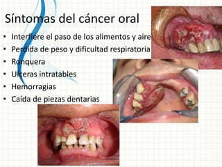 Síntomas del cáncer oral
• Interfiere el paso de los alimentos y aire
• Perdida de peso y dificultad respiratoria
• Ronquera
• Ulceras intratables
• Hemorragias
• Caída de piezas dentarias
 