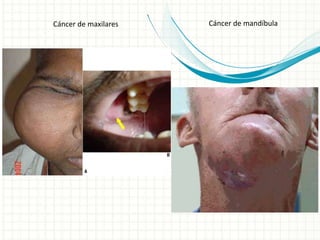Cáncer de maxilares Cáncer de mandíbula
 