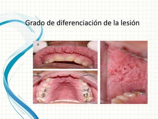 Grado de diferenciación de la lesión
 