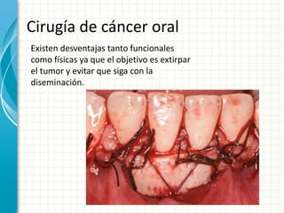 Cirugía de cáncer oral
Existen desventajas tanto funcionales
como físicas ya que el objetivo es extirpar
el tumor y evitar que siga con la
diseminación.
 