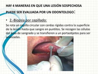 HAY 4 MANERAS EN QUE UNA LESIÓN SOSPECHOSA
PUEDE SER EVALUADA POR UN ODONTOLOGO:
• 2.-Biopsia por cepillado:
Se rota un cepillo circular con cerdas rígidas contra la superficie
de la lesión hasta que sangre en puntitos. Se recogen las células
del área de sangrado y se transfieren a un portaobjetos para ser
analizadas.
 