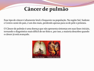 Esse tipo de câncer é altamente letal e frequente na população. Na região Sul, Sudeste
e Centro-oeste do país, é um dos mais, perdendo apenas para os de pele e próstata.
O Câncer de pulmão é uma doença que não apresenta sintomas em suas fases iniciais,
tornando o diagnóstico mais difícil de ser feito e, por isso, a maioria descobre quando
o câncer já está avançado.
Câncer de pulmão
 