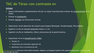 TAC de Tórax con contraste ev
Utilidad:
 Aporta información complementaria útil por su mayor exactitud para evaluar las características de la
lesión.
 Evaluar la localización.
 Evaluar relación con estructuras vecinas.
 Seleccionar vía de obtención de muestra para biopsia (Bronquial, Transbronquial, Percutánea).
 Superior a la Rx en lesiones pequeñas menor a 1 cm.
 Superior a la Rx en mediastino, hilios y estructuras de la pared torácica.
 Importante rol en la Estadificación (TNM):
 Tamaño (T)
 Compromiso de Linfonodos regionales (N)
 Metástasis intra o extratorácicas (M)
Karl W Thomas, MD, et al. Overview of the initial evaluation, diagnosis, and staging of patients with suspected lung cáncer. Literature review
current through: Apr 2015.
 