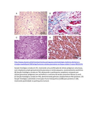 http://www.elsevier.pt/pt/revistas/revista-portuguesa-estomatologia-medicina-dentaria-e-
cirurgia-maxilofacial-330/artigo/tumores-celulas-granulares-na-lingua-relato-2-casos-90151576

Secção histológica corada em HE, mostrando uma proliferação de células poligonais volumosas,
com citoplasma amplo grosseiramente granuloso e núcleo pequeno, ocasionalmente excêntrico.
(B) Secção histológica corada em TM, destacando o parênquima neoplásico composto por
células granulosas poligonais (em vermelho) e o estroma de tecido conjuntivo fibroso (a azul).
(C) Secção histológica corada em PAS, demonstrando grânulos citoplasmáticos PAS-positivos. (D)
Secção histológica submetida à marcação imuno-histoquímica (LSAB) para proteína S-100,
mostrando positividade no parênquima tumoral.
 