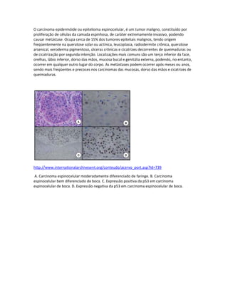 O carcinoma epidermóide ou epitelioma espinocelular, é um tumor maligno, constituído por
proliferação de células da camada espinhosa, de caráter extremamente invasivo, podendo
causar metástase. Ocupa cerca de 15% dos tumores epiteliais malignos, tendo origem
freqüentemente na queratose solar ou actínica, leucoplasia, radiodermite crônica, queratose
arsenical, xeroderma pigmentoso, úlceras crônicas e cicatrizes decorrentes de queimaduras ou
de cicatrização por segunda intenção. Localizações mais comuns são um terço inferior da face,
orelhas, lábio inferior, dorso das mãos, mucosa bucal e genitália externa, podendo, no entanto,
ocorrer em qualquer outro lugar do corpo. As metástases podem ocorrer após meses ou anos,
sendo mais freqüentes e precoces nos carcinomas das mucosas, dorso das mãos e cicatrizes de
queimaduras.




http://www.internationalarchivesent.org/conteudo/acervo_port.asp?Id=739

A. Carcinoma espinocelular moderadamente diferenciado de faringe. B. Carcinoma
espinocelular bem diferenciado de boca. C. Expressão positiva da p53 em carcinoma
espinocelular de boca. D. Expressão negativa da p53 em carcinoma espinocelular de boca.
 