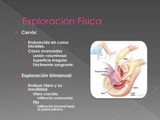    Cervix:

     Endurecido en casos
      iniciales.
    › Casos avanzados
        Lesión voluminosa
        Superficie irregular
        Fácilmente sangrante.

   Exploración bimanual:

    › Evaluar útero y su
      movilidad.
       Utero crecido
          Infiltración endometrial.
        Fijo
          Infiltración tumoral hasta
           la pared pélvica.
 