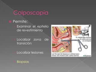    Permite:
    › Examinar el epitelio
      de revestimiento

    › Localizar    zona de
      transición

    › Localizar lesiones


    › Biopsias
 