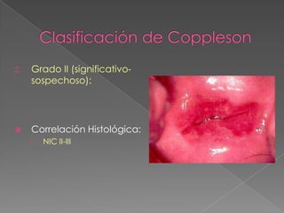 2.   Grado II (significativo-
     sospechoso):




    Correlación Histológica:
     ›   NIC II-III
 