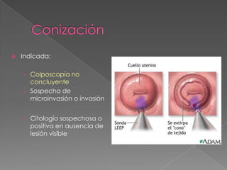    Indicada:

    › Colposcopía no
      concluyente
    › Sospecha de
      microinvasión o invasión


    › Citología sospechosa o
      positiva en ausencia de
      lesión visible
 