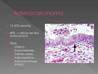    15-20% restante.

   80%  células de tipo
    endocervical

   Tipos:
     1. Clásico.
     2. Endometrioide.
     3. Células claras.
     4. Adenoquístico.
     5. Adenoescamoso
        (mixto).
 