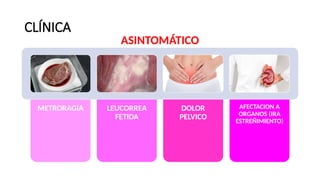 CLÍNICA
METRORAGIA LEUCORREA
FETIDA
DOLOR
PELVICO
AFECTACION A
ORGANOS (IRA
ESTREÑIMIENTO)
ASINTOMÁTICO
 