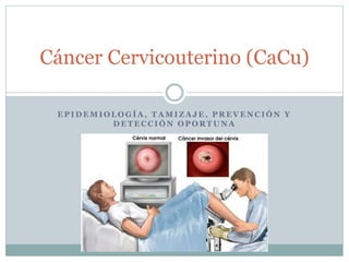 Cáncer Cervicouterino (CaCu) 
EPIDEMIOLOGÍA, TAMIZAJE, PREVENCIÓN Y 
DETECCIÓN OPORTUNA 
 