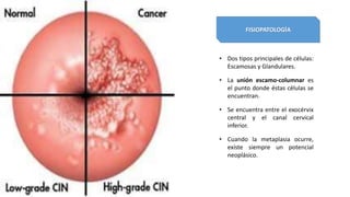 FISIOPATOLOGÍA
• Dos tipos principales de células:
Escamosas y Glandulares.
• La unión escamo-columnar es
el punto donde éstas células se
encuentran.
• Se encuentra entre el exocérvix
central y el canal cervical
inferior.
• Cuando la metaplasia ocurre,
existe siempre un potencial
neoplásico.
 