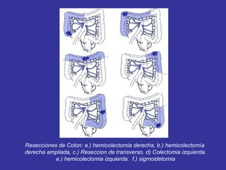Resecciones de Colon: a.) hemicolectomia derecha, b.) hemicolectomía
derecha ampliada, c.) Reseccion de transverso. d) Colectomia izquierda.
           e.) hemicolectomia izquierda. f.) sigmoidetomia
 