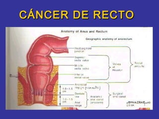 CÁNCER DE RECTO
 