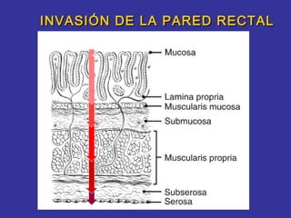 INVASIÓN DE LA PARED RECTAL

     +
 