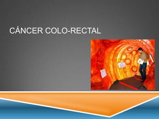 CÁNCER COLO-RECTAL
 