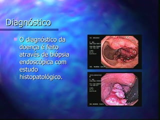 Diagnóstico
    O diagnóstico da
     doença é feito
     através de biópsia
     endoscópica com
     estudo
     histopatológico.
 
