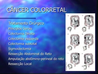CÂNCER COLORRETAL

Tratamento Cirúrgico
Princípios Gerais
Colectomia Direita
Colectomia esquerda
Colectomia subtotal
Sigmoidectomia
Ressecção Abdominal do Reto
Amputação abdômino-perineal do reto
Ressecção Local
 