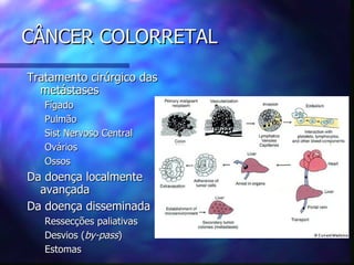 CÂNCER COLORRETAL
Tratamento cirúrgico das
  metástases
   Fígado
   Pulmão
   Sist Nervoso Central
   Ovários
   Ossos
Da doença localmente
  avançada
Da doença disseminada
   Ressecções paliativas
   Desvios (by-pass)
   Estomas
 