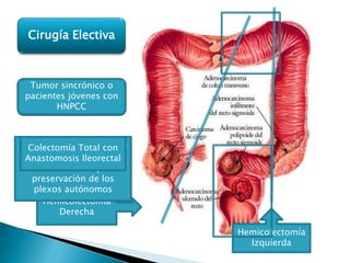Cirugía Electiva



  Tumor sincrónico o
    Tumor en Colon
    Tumor en Ciego,
    Tumor en Colon
 pacientes jóvenes con
    Tumor de Recto
     Descendente y
  Colon Ascendente o
   Transverso Distal
       Sigmoides
         HNPCC
  Transverso proximal


        Resección
    Hemicolectomía
 Resección Transanal –
Resto: Resección Anterior
  Colectomía Total con
   Abdominoperineal
  Derecha resección del
  Tercio Extendida o
 Baja coninferior recto
 Anastomosis Ileorectal
Op. Miles – Tumores bajo
        Izquierda
     (últimos 7 cm)
      mesorrecto y
   5 cms margen anal
   preservación de los
   plexos autónomos
     Hemicolectomía
          Derecha

                            Hemicolectomía
                              Izquierda
 