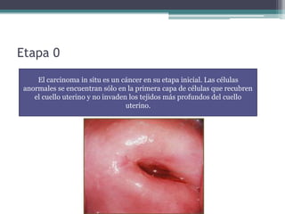 Etapa 0
El carcinoma in situ es un cáncer en su etapa inicial. Las células
anormales se encuentran sólo en la primera capa de células que recubren
el cuello uterino y no invaden los tejidos más profundos del cuello
uterino.
 