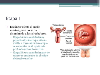 Etapa I
• El cáncer afecta el cuello
uterino, pero no se ha
diseminado a los alrededores.
▫ Etapa IA: una cantidad muy
pequeña de cáncer que sólo es
visible a través del microscopio
se encuentra en el tejido más
profundo del cuello uterino
▫ Etapa IB: una cantidad mayor de
cáncer se encuentra en el tejido
del cuello uterino
 
