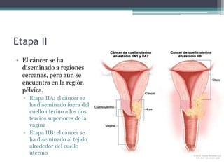 Etapa II
• El cáncer se ha
diseminado a regiones
cercanas, pero aún se
encuentra en la región
pélvica.
▫ Etapa IIA: el cáncer se
ha diseminado fuera del
cuello uterino a los dos
tercios superiores de la
vagina
▫ Etapa IIB: el cáncer se
ha diseminado al tejido
alrededor del cuello
uterino
 