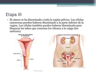 Etapa III
• El cáncer se ha diseminado a toda la región pélvica. Las células
cancerosas pueden haberse diseminado a la parte inferior de la
vagina. Las células también pueden haberse diseminado para
bloquear los tubos que conectan los riñones a la vejiga (los
uréteres).
 