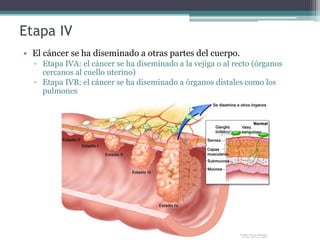 Etapa IV
• El cáncer se ha diseminado a otras partes del cuerpo.
▫ Etapa IVA: el cáncer se ha diseminado a la vejiga o al recto (órganos
cercanos al cuello uterino)
▫ Etapa IVB: el cáncer se ha diseminado a órganos distales como los
pulmones
 