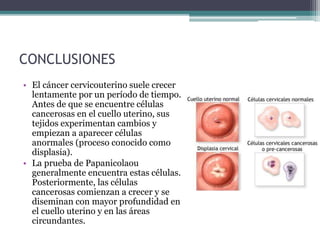 CONCLUSIONES
• El cáncer cervicouterino suele crecer
lentamente por un período de tiempo.
Antes de que se encuentre células
cancerosas en el cuello uterino, sus
tejidos experimentan cambios y
empiezan a aparecer células
anormales (proceso conocido como
displasia).
• La prueba de Papanicolaou
generalmente encuentra estas células.
Posteriormente, las células
cancerosas comienzan a crecer y se
diseminan con mayor profundidad en
el cuello uterino y en las áreas
circundantes.
 