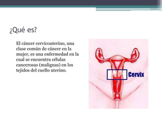 ¿Qué es?
El cáncer cervicouterino, una
clase común de cáncer en la
mujer, es una enfermedad en la
cual se encuentra células
cancerosas (malignas) en los
tejidos del cuello uterino.
 