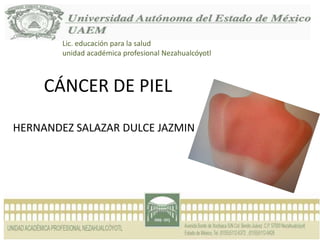 CÁNCER DE PIEL
HERNANDEZ SALAZAR DULCE JAZMIN
Lic. educación para la salud
unidad académica profesional Nezahualcóyotl
 