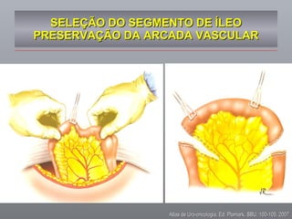 SELEÇÃO DO SEGMENTO DE ÍLEO PRESERVAÇÃO DA ARCADA VASCULAR Atlas de Uro-oncologia, Ed. Plamark, SBU, 100-105, 2007 