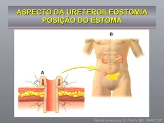 ASPECTO DA URETEROILEOSTOMIA POSIÇÃO DO ESTOMA Atlas de Uro-oncologia, Ed. Plamark, SBU, 100-105, 2007 