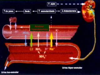 Acidose  hipercloremica 