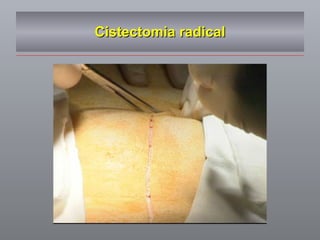 Cistectomia radical 