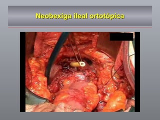 Neobexiga ileal ortotópica 