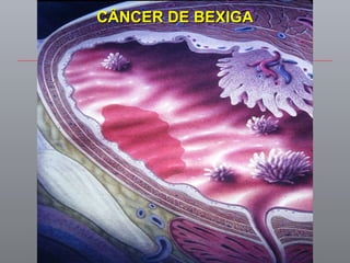CÂNCER DE BEXIGA 