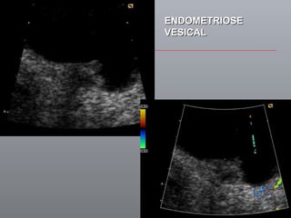 ENDOMETRIOSE VESICAL 