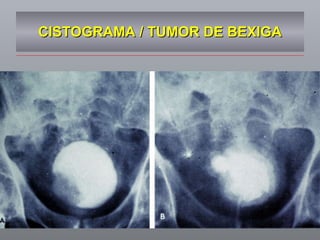 CISTOGRAMA / TUMOR DE BEXIGA 