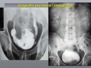 Urografia excretora / cistograma 
