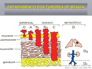 ESTADIAMENTO DOS TUMORES DE BEXIGA Câncer urológico, Miguel Srougi, Ed. Platina, cap. 9, 173-278 - 2002  Jewett H, J Strong, J. Urol. 55;366, 1946 