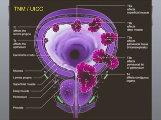 TNM / UICC 