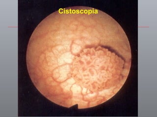 Cistoscopia 