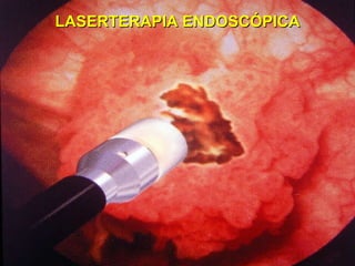 LASERTERAPIA ENDOSCÓPICA 