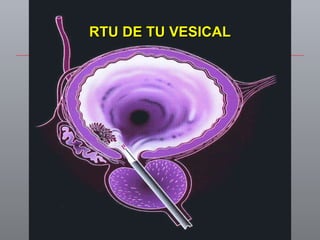 RTU DE TU VESICAL 