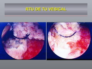 RTU DE TU VESICAL 