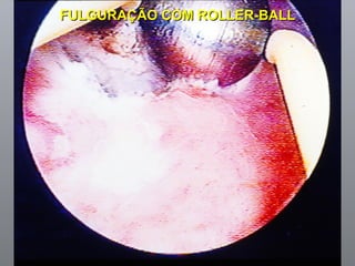 FULGURAÇÃO COM ROLLER-BALL 